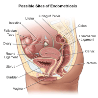 Endometriosis diagram of menstrual cramps 