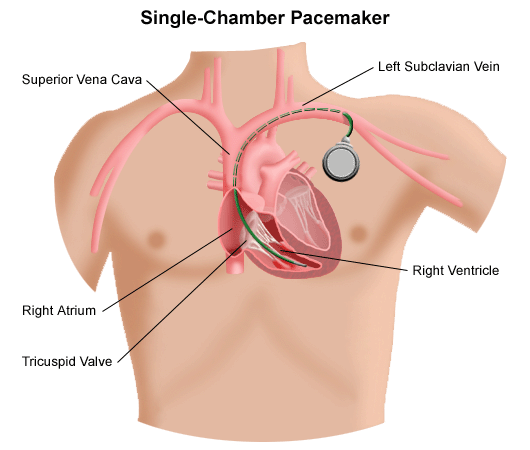 Single versus double chamber pacemaker