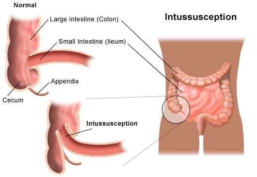 Best Food For Bowel Obstruction Best Food For Bowel Obstruction