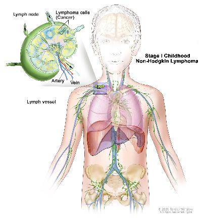 Stage I childhood non-Hodgkin lymphoma; drawing shows cancer in one group of lymph nodes. An inset shows a lymph node with a lymph vessel, an artery, and a vein. Lymphoma cells containing cancer are shown in the lymph node.