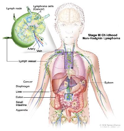 Stage III childhood non-Hodgkin lymphoma; drawing shows cancer in lymph node groups above and below the diaphragm, in the chest, and throughout the abdomen in the liver, spleen, small intestines, and appendix. The colon is also shown. An inset shows a lymph node with a lymph vessel, an artery, and a vein. Lymphoma cells containing cancer are shown in the lymph node.