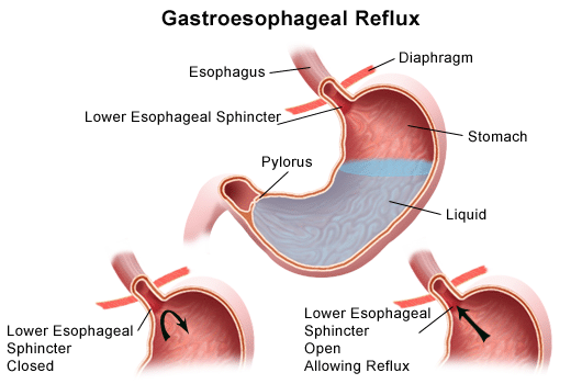 Illustration demonstrating gastroesophageal reflux