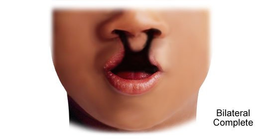 bilateral cleft lip