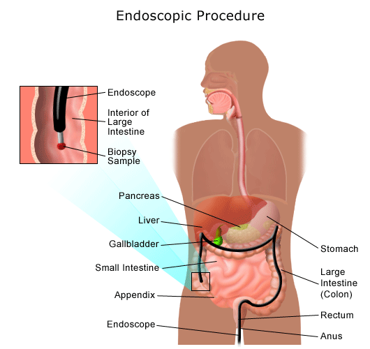 What are the signs of irritable bowel syndrome?