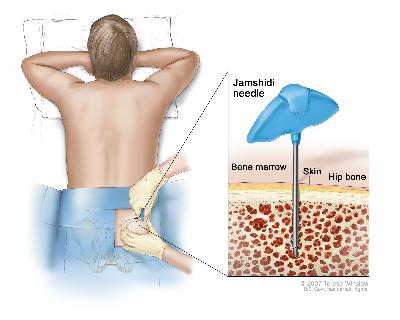 Bone marrow aspiration and biopsy; drawing shows a patient lying face down on a table and a Jamshidi needle (a long, hollow needle) being inserted into the hip bone. Inset shows the Jamshidi needle being inserted through the skin into the bone marrow of the hip bone.