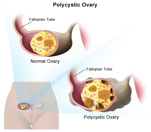 Data mining DNA for polycystic ovary syndrome genes 