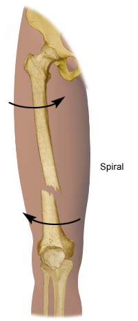Fractures in Children