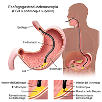 Ilustración de un procedimiento de eofagogastroduodenoscopía