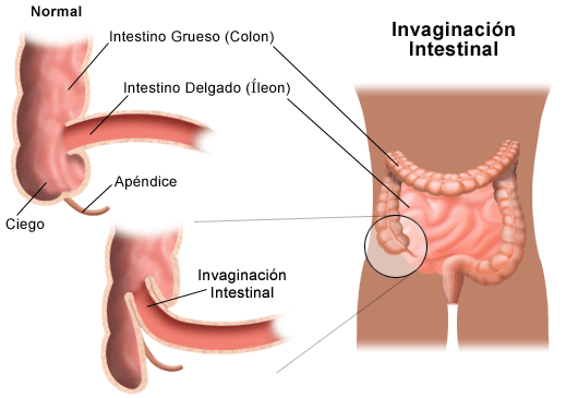 Invaginación Intestinal