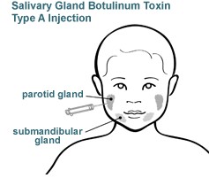 Salivary Gland Botulinum Toxin Type A Injection