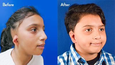 9-year-old Male with Right Grade 2