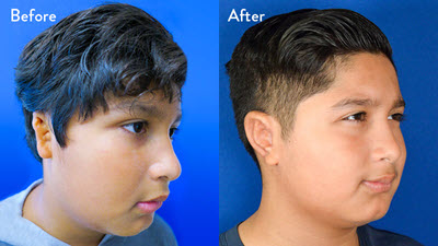 9-year-old Male with Right Grade 2 Microtia Before and After RibCartilage Graft Repair