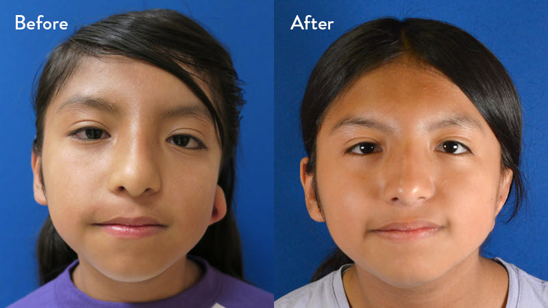 Grade 2 microtia before and after
