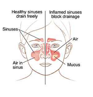 6 Signs of a Sinus Infection - Montgomery County ENT Institute