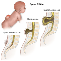 Ilustración de los tres tipos de espina bífida