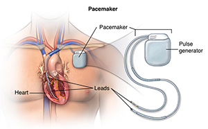Illustration of a pacemaker device and the location where it is placed in the chest