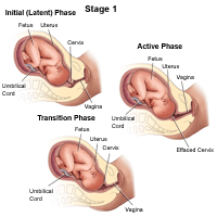 Illustration demonstrating the stage 1 of labor