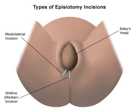 Image result for episiotomy