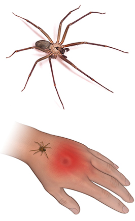 brown recluse spider bite