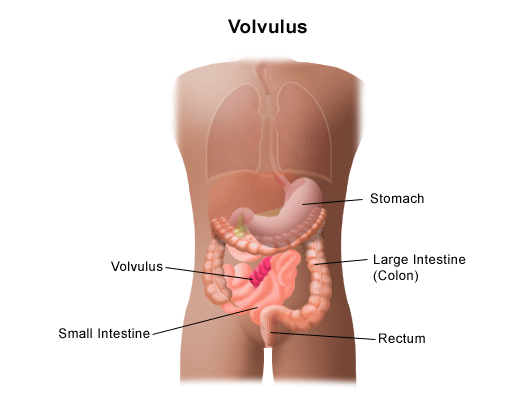 Intestinal Malrotation and Volvulus diagram of cecal volvulus 