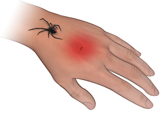 Symptoms of Venomous Spider Bites - StoryMD