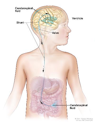 Cerebrospinal fluid (CSF) diversion; drawing shows extra CSF flowing through a tube (shunt) from a ventricle in the brain into the abdomen. The shunt goes from the ventricle, under the skin in the neck and chest, and into the abdomen. Also shown is a valve that controls the flow of CSF.