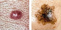 Foto que compara un lunar normal y un melanoma que presenta asimetría