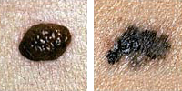 Foto que compara un lunar normal y un melanoma de bordes irregulares