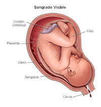 Ilustración de hemorragias visibles durante el embarazo.