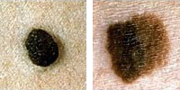 Foto que compara un lunar normal y un melanoma con variación de color