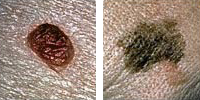 Foto que compara un lunar normal y un melanoma con variación de diámetro