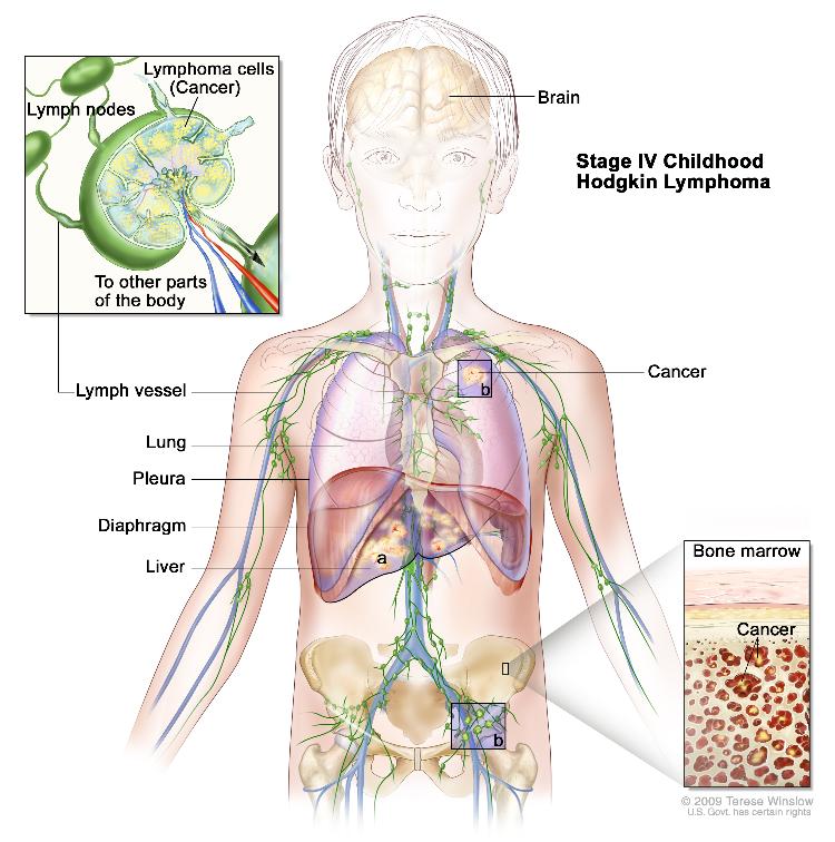 Childhood Hodgkin Lymphoma Treatment (PDQ®)