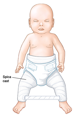 Hip dislocation in babies sales