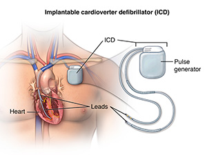 Illustration showing the ICD device and the location when placed in the chest