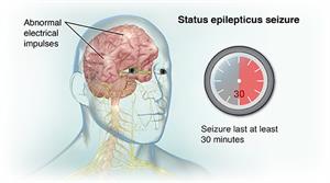 Status Epilepticus Seizure