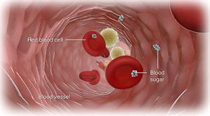 Hypoglycemia