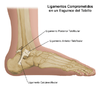 Dibujo que demuestra los tres ligamentos comprometidos en los esguinces/torceduras del tobillo