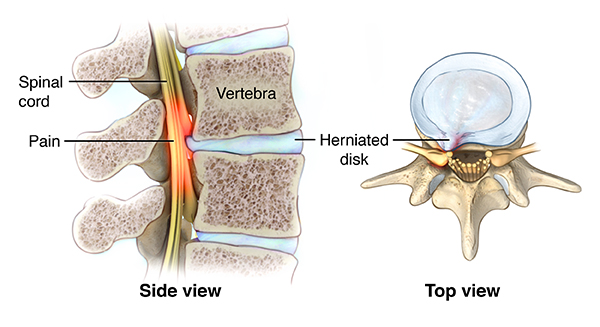 Pinched Nerve - Stanford Medicine Children's Health