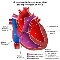 Ilustración de la anatomía de corazón con una comunicación interauricular