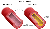 Ilustración de una arteria normal y una arteria enferma