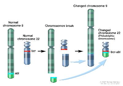 Philadelphia chromosome; three-panel drawing shows a piece of chromosome 9 and a piece of chromosome 22 breaking off and trading places, creating a changed chromosome 22 called the Philadelphia chromosome. In the left panel, the drawing shows a normal chromosome 9 with the abl gene and a normal chromosome 22 with the bcr gene. In the center panel, the drawing shows chromosome 9 breaking apart in the abl gene and chromosome 22 breaking apart below the bcr gene. In the right panel, the drawing shows chromosome 9 with the piece from chromosome 22 attached and chromosome 22 with the piece from chromosome 9 containing part of the abl gene attached. The changed chromosome 22 with bcr-abl gene is called the Philadelphia chromosome.