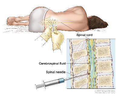 Lumbar puncture; drawing shows a patient lying in a curled position on a table and a spinal needle (a long, thin needle) being inserted into the lower back. Inset shows a close-up of the spinal needle inserted into the cerebrospinal fluid (CSF) in the lower part of the spinal column.