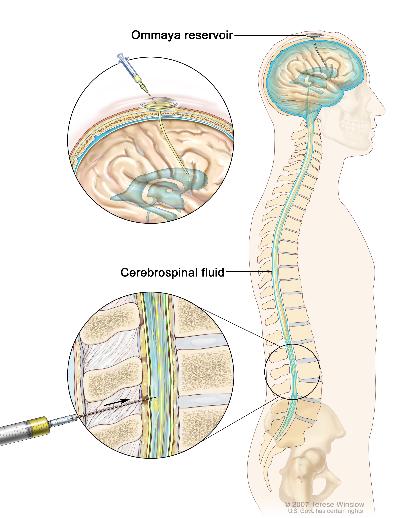 Intrathecal chemotherapy; drawing shows the cerebrospinal fluid (CSF) in the brain and spinal cord, and an Ommaya reservoir (a dome-shaped container that is placed under the scalp during surgery; it holds the drugs as they flow through a small tube into the brain). Top section shows a syringe and needle injecting anticancer drugs into the Ommaya reservoir. Bottom section shows a syringe and needle injecting anticancer drugs directly into the cerebrospinal fluid in the lower part of the spinal column.