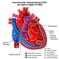 Anatomía de un corazón con una comunicación interventricular