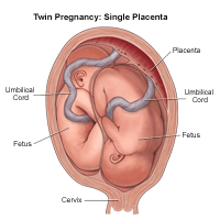 Illustration of a twin birth, head down/head down; 1 placenta, 2 cords