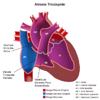 Anatomía de un corazón con una atresia tricuspídea
