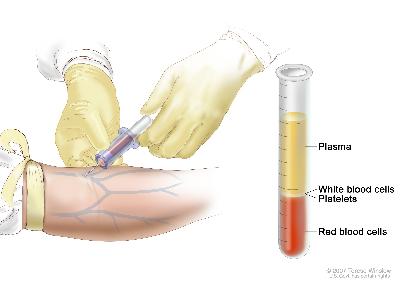 Complete blood count (CBC); left panel shows blood being drawn from a vein on the inside of the elbow using a tube attached to a syringe; right panel shows a laboratory test tube with blood cells separated into layers: plasma, white blood cells, platelets, and red blood cells. 