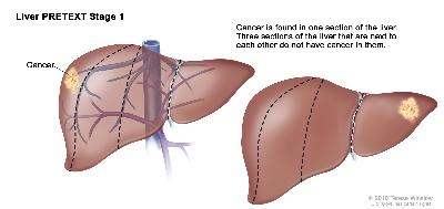 Liver PRETEXT Stage 1; drawing shows two livers. Dotted lines divide each liver into four vertical sections of about the same size. In the first liver, cancer is shown in the section on the far left. In the second liver, cancer is shown in the section on the far right.