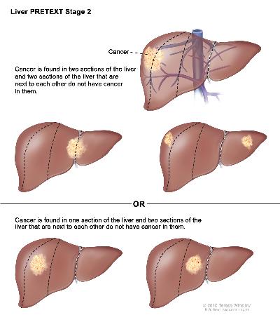Liver PRETEXT Stage 2; drawing shows five livers. Dotted lines divide each liver into four vertical sections that are about the same size. In the first liver, cancer is shown in the two sections on the left. In the second liver, cancer is shown in the two sections on the right. In the third liver, cancer is shown in the far left and far right sections. In the fourth liver, cancer is shown in the second section from the left. In the fifth liver, cancer is shown in the second section from the right.
