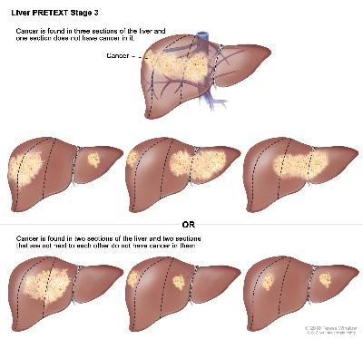 Liver PRETEXT Stage 3; drawing shows seven livers. Dotted lines divide each liver into four vertical sections that are about the same size. In the first liver, cancer is shown in three sections on the left. In the second liver, cancer is shown in the two sections on the left and the section on the far right. In the third liver, cancer is shown in the section on the far left and the two sections on the right. In the fourth liver, cancer is shown in three sections on the right. In the fifth liver, cancer is shown in the two middle sections. In the sixth liver, cancer is shown in the section on the far left and the second section from the right. In the seventh liver, cancer is shown in the section on the far right and the second section from the left.